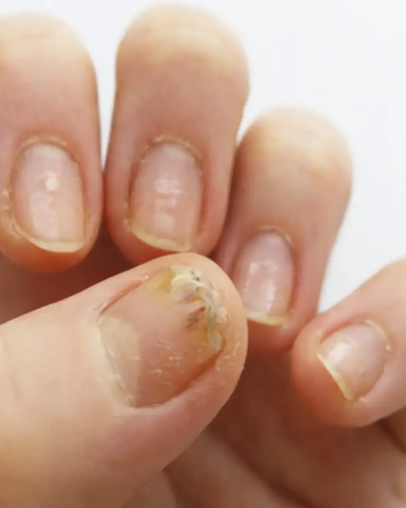 alergija na noktima cici nails